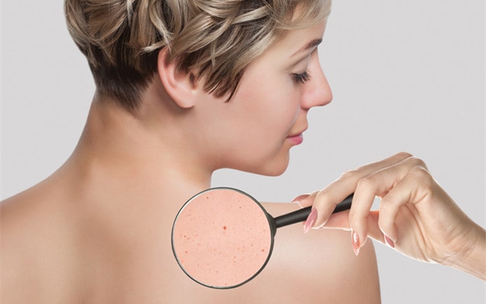 Como melhorar a acne nas costas